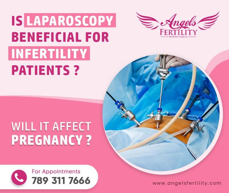Is Laparoscopy Beneficial for Infertility Patients? Will It Affect Pregnancy?